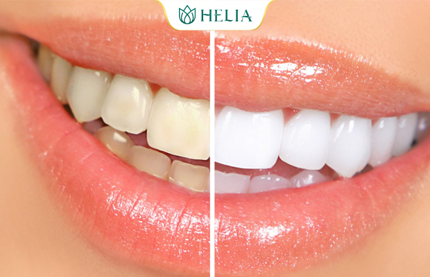 Răng ố vàng làm sao để trắng tại nhà Răng ố vàng làm soa để trắng tại nhà