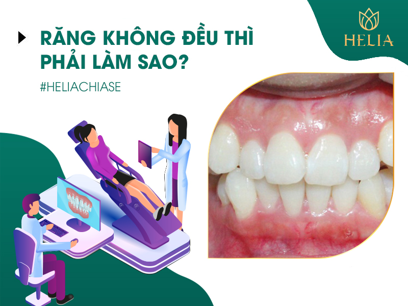 Hỏi đáp: Răng không đều phải làm sao? Khách hàng sử dụng dịch vụ bọc răng sứ Pico Zolid Đức khắc phục tình trạng răng không đều