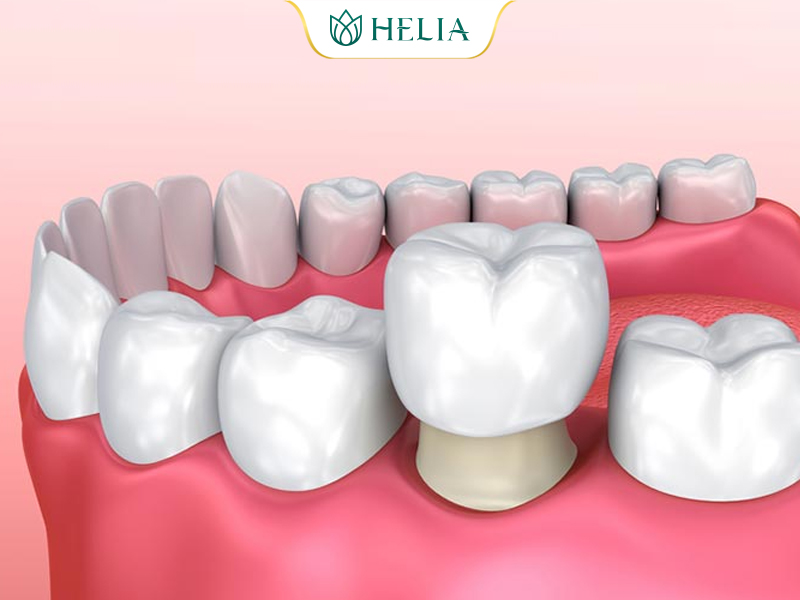 Trường hợp nên và không nên bọc răng sứ Bọc răng sứ - Bảo vệ răng bị chết tuỷ